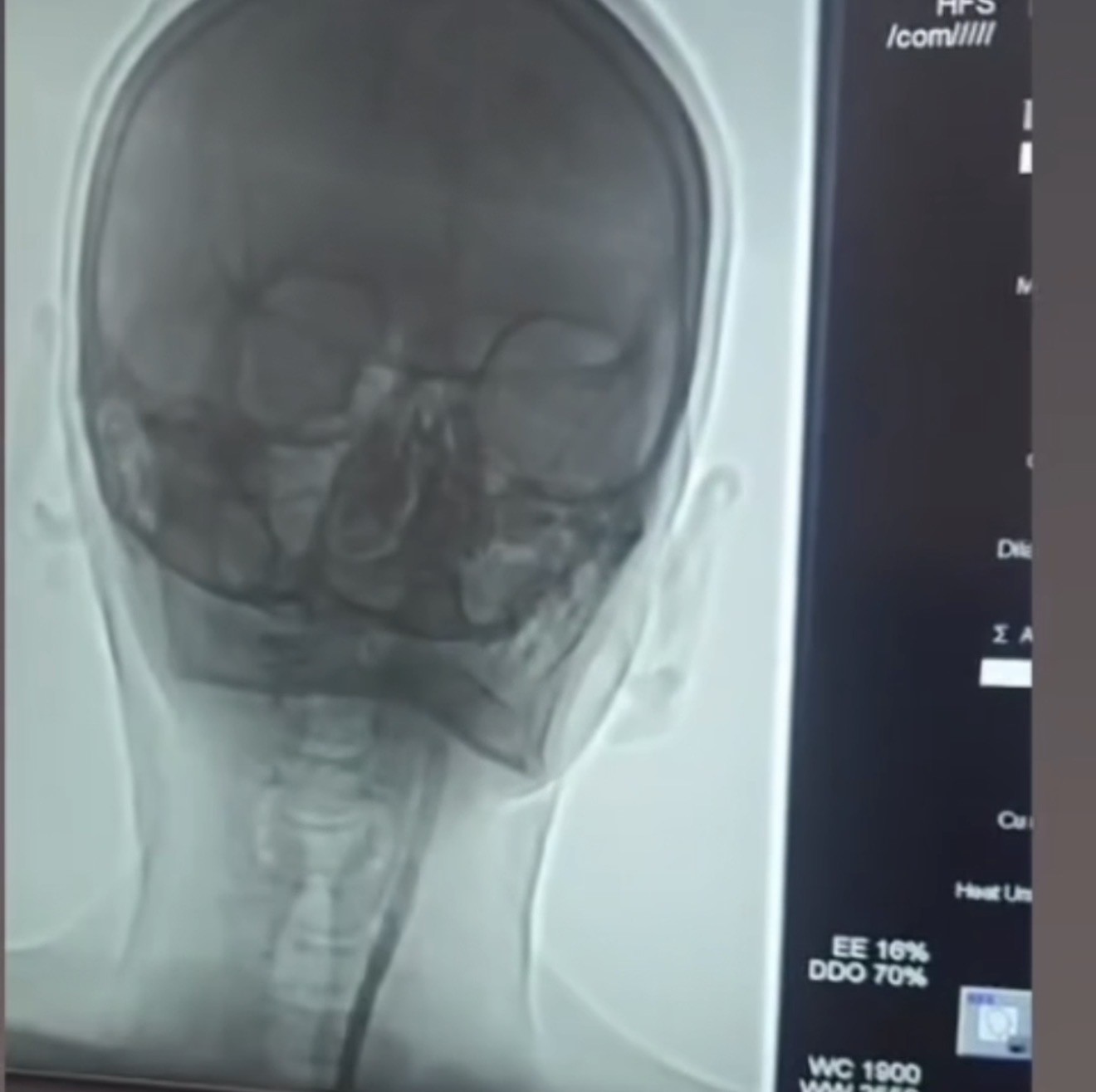 Iğdır’da şah damarı darlığına stentli müdahale